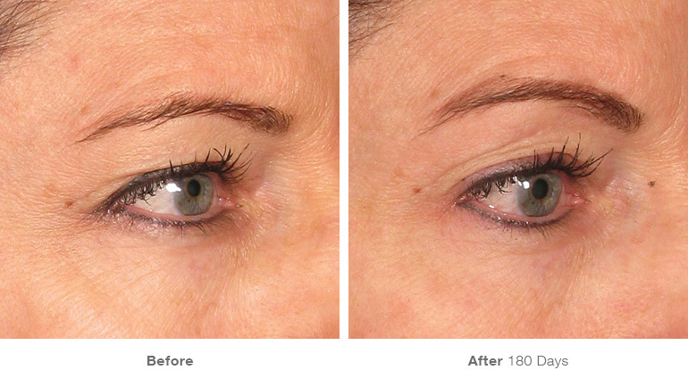 ultherapy brow template lift before beforeafter neck tightening non surgical lifting el eyes surgery facelift paso chin plastic courtesy treatment