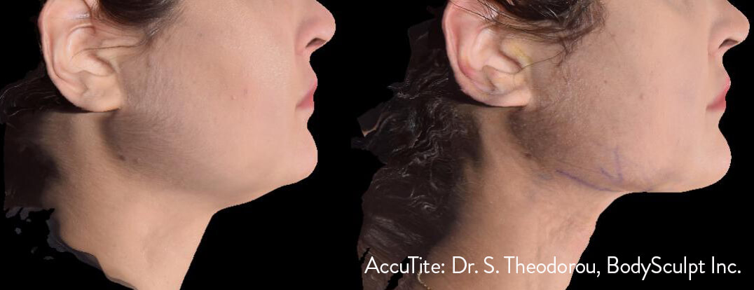 AccuTite™ Patient 2