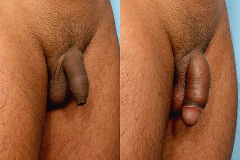 Penis Enhancement and Enlargement