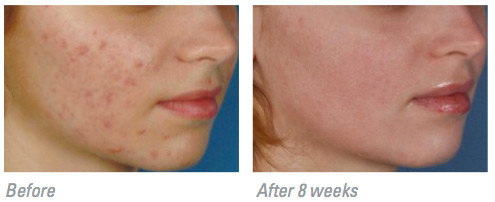 Zo Medical acne scars actual patient results