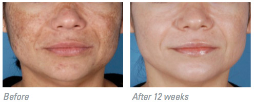 Zo Medical hyperpigmentation patient results
