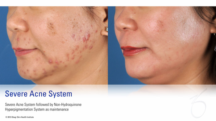 ZO Skin Health Severe acne system actual patient results
