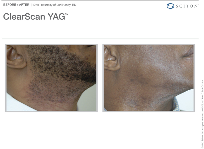 ClearScan YAG laser hair removal patient