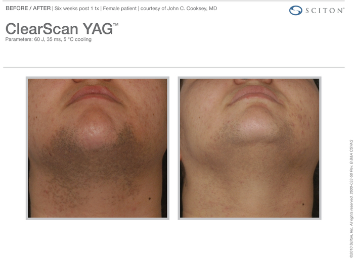 ClearScan YAG actual patient results