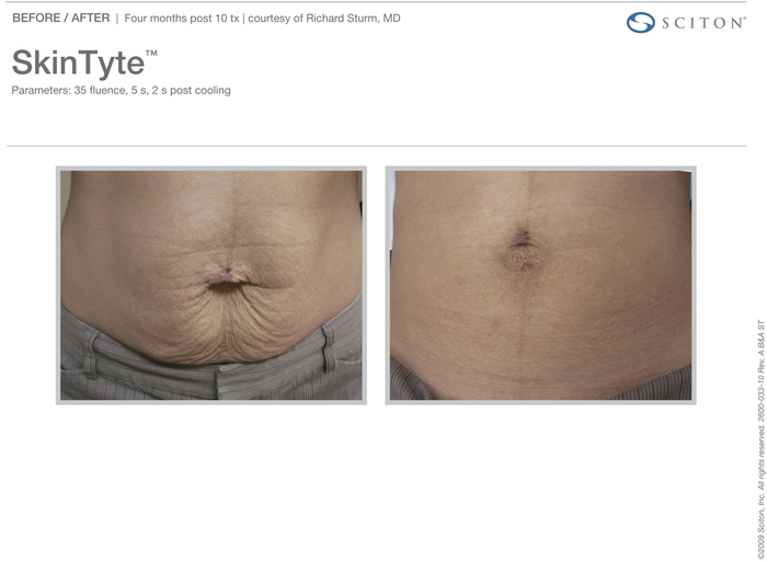 SkinTyte actual patient abs results