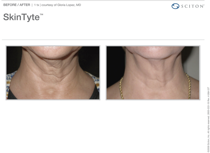 SkinTyte actual patient neck results