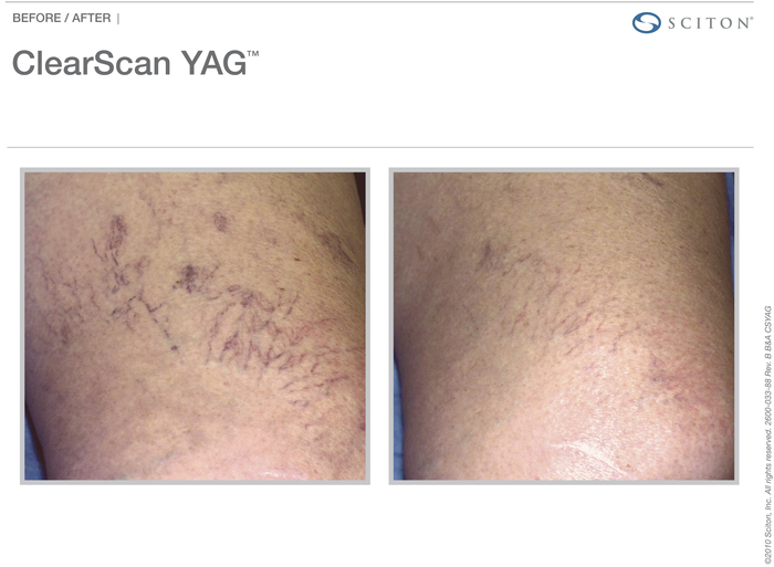 ClearScan actual patient vein results