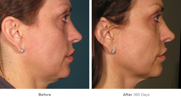 Ultherapy® Results Before and After Photos
