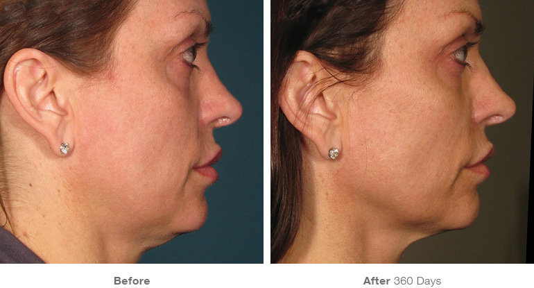 before_after_ultherapy_results_full-face3