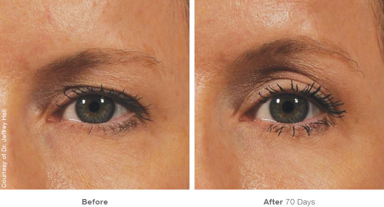 img_template_beforeafter_brow12