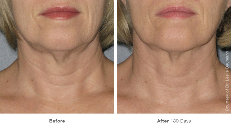 ultherapy-0025-0086w_180day_1tx_neck_gallery