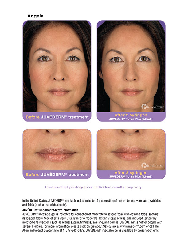 Juvederm Actual Patient Results