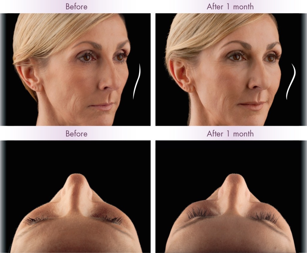 Juvederm Voluma Actual Patient