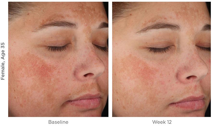 Lytera Skin Brightening Complex actual patient results