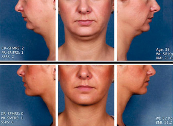 kybella-results