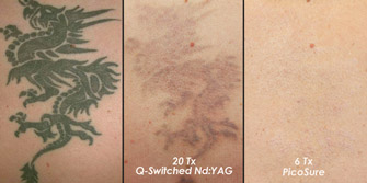 Laser Tattoo Removal Actual Patient 8