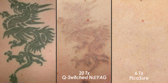 Laser Tattoo Removal Actual Patient 8