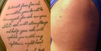 Laser Tattoo Removal Actual Patient 2