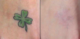 Laser Tattoo Removal Actual Patient 7