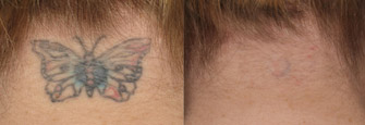 Laser Tattoo Removal Actual Patient 4