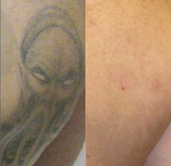 Laser Tattoo Removal Actual Patient 9