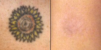 Laser Tattoo Removal Actual Patient 6