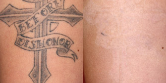 Laser Tattoo Removal Actual Patient 5