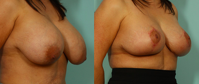 Breast Reduction Before & After Photo