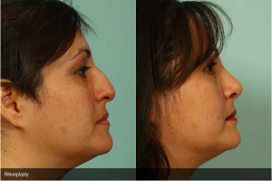 Rhinoplasty Before and After Photos