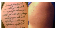 Tattoo Removal Before and After Photos