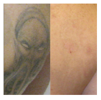 Tattoo Removal Before & After Photos