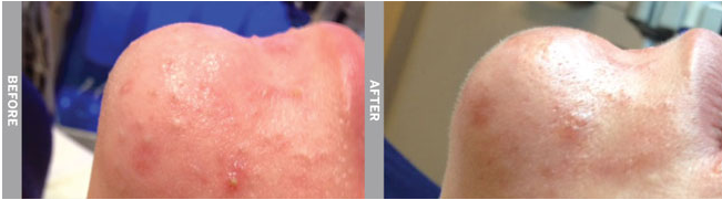 HydraFacial MD Before and After