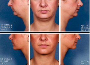 KYBELLA® Before and After