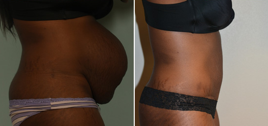 Tummy Tuck Before and After Photos