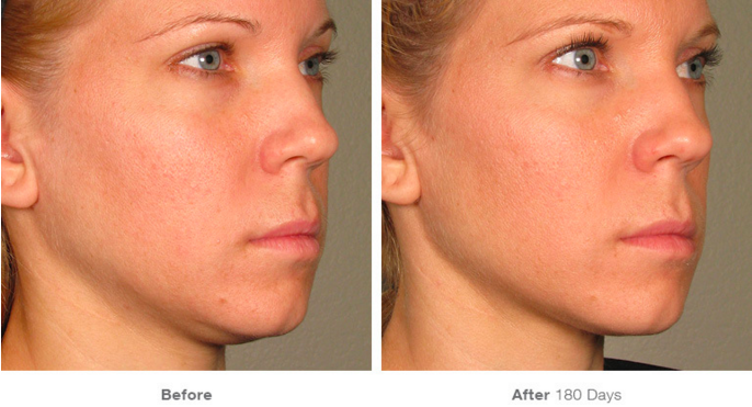 Before and After Ultherapy®