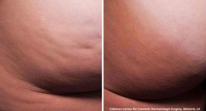 Cellfina™ Cellulite Treatment Before and After Photos