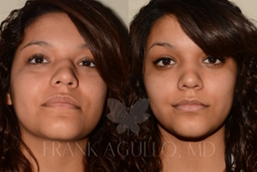 Rhinoplasty Before and After Photos