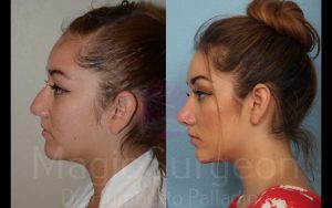 Rhinoplasty Before and After Photos