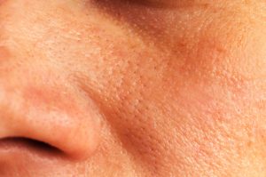 Beauty: The Ultimate Cosmetic Makeover Guide » Enlarged pores