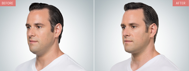 Kybella Patient before and after