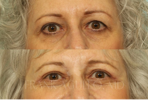 Dr. Agullo Blepharoplasty patient