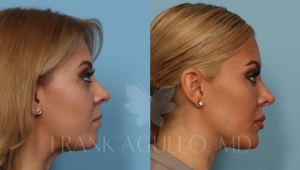 Chin Implant patient by Dr. Agullo