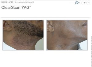 South West Plastic Surgery Clear Scan YAG Laser hair removal marketing photo