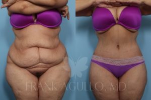 Agullo Tummy Tuck Patient