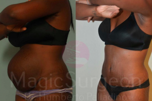 tummy Tuck Patient