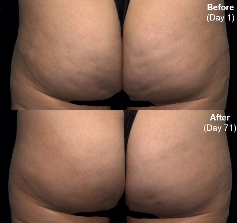 Qwo® (Cellulite Injection Treatment) actual patient results 2