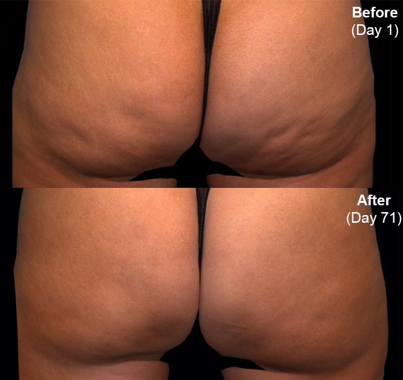 Qwo® (Cellulite Injection Treatment) actual patient results