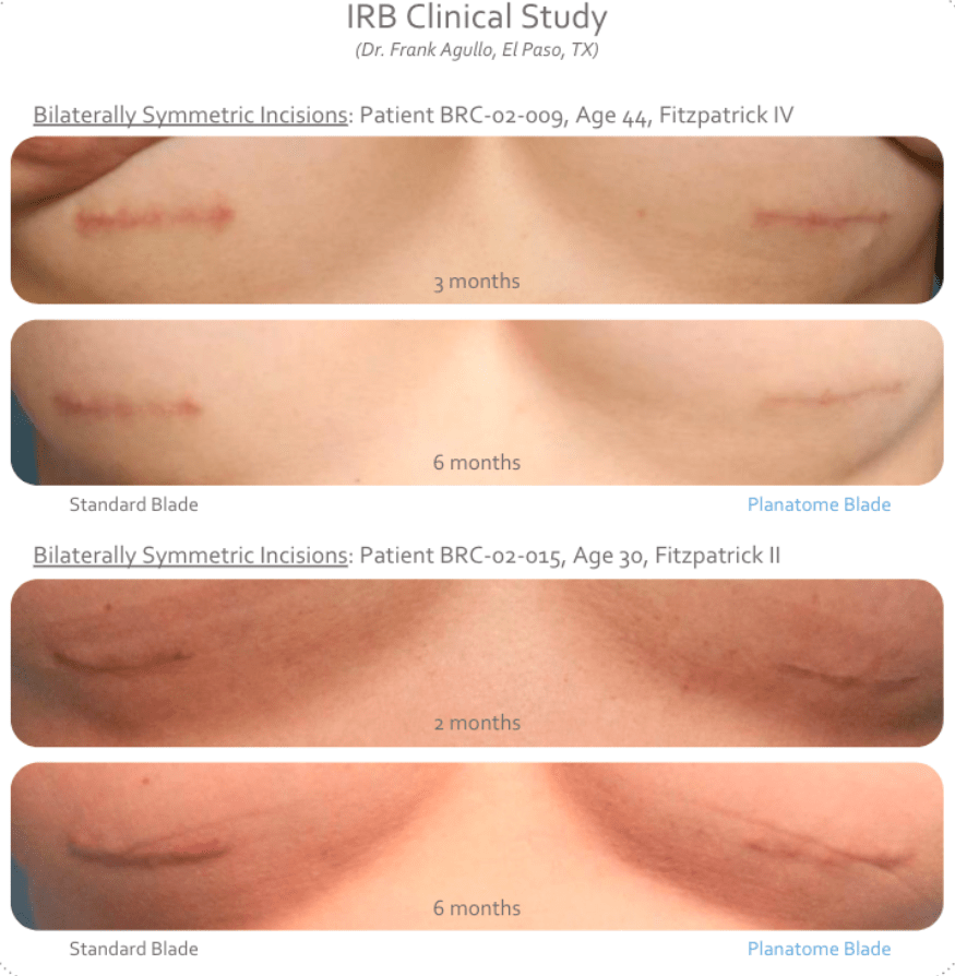 Case study showing the healing of incisions using different surgical blades.