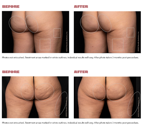 Before and after image showing the results of Aveli cellulite treatment.