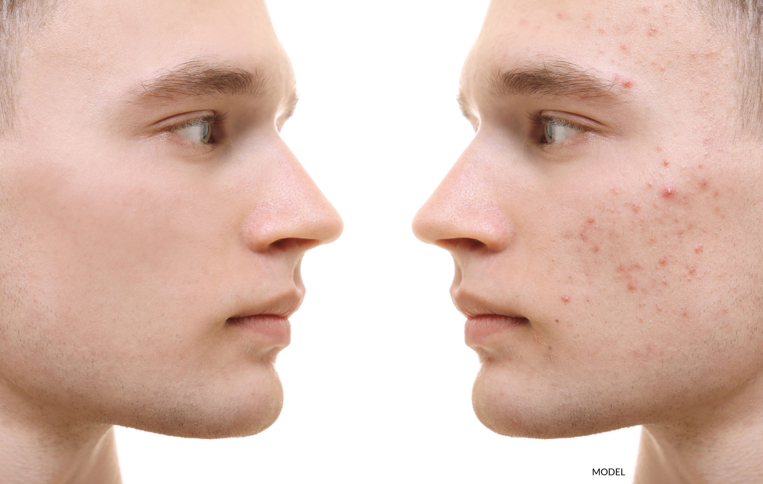 A young man before and after acne treatment.